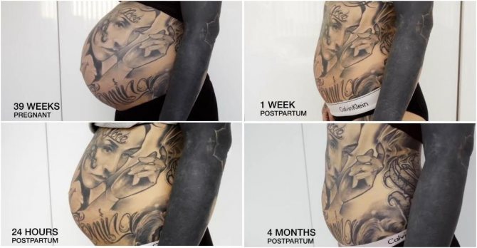What happens to a tattoo when you gain or lose weight