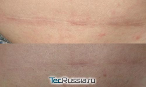 Before and after using Contraktubex ointment on the cesarean scar