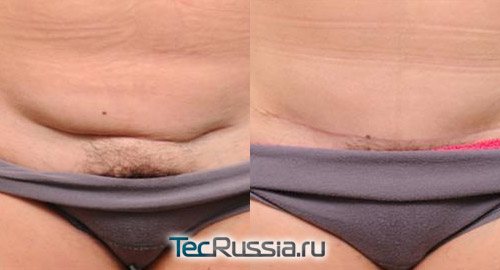 before and after excision of the scar with skin folds