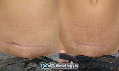 Before and after laser correction of the horizontal abdominal scar
