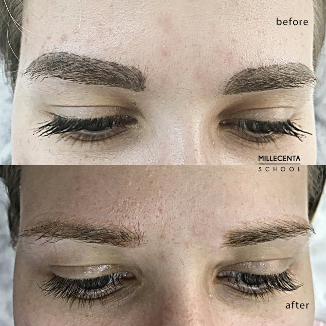 Pigment inversion, before-after photos - 6 month after effects
