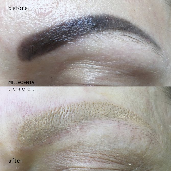 Pigment inversion, photo-before-after-laser-brow removal