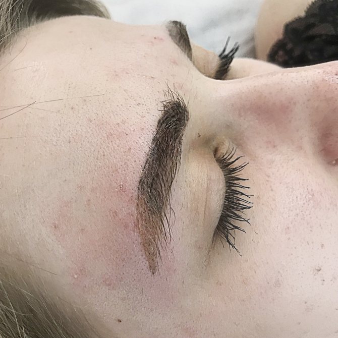 Pigment inversion. Removal of eyebrows with a laser.