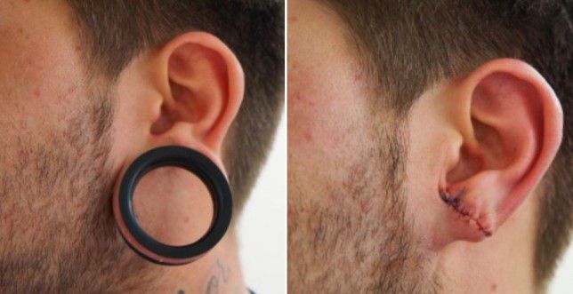 How to do tunnels in the ears care complications