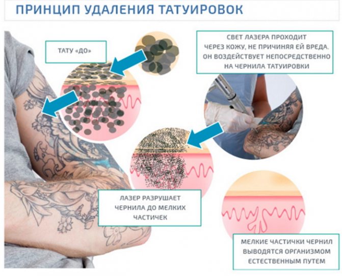Cum să scapi de un tatuaj, îndepărtarea unui tatuaj la domiciliu