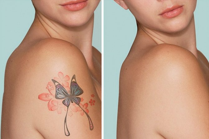 How to remove tattoos with a laser