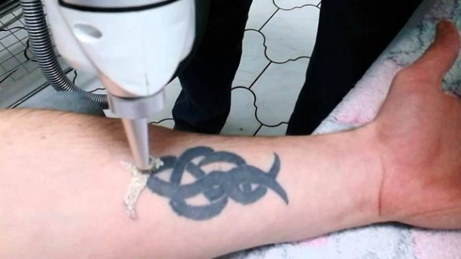 How to remove a tattoo without a scar