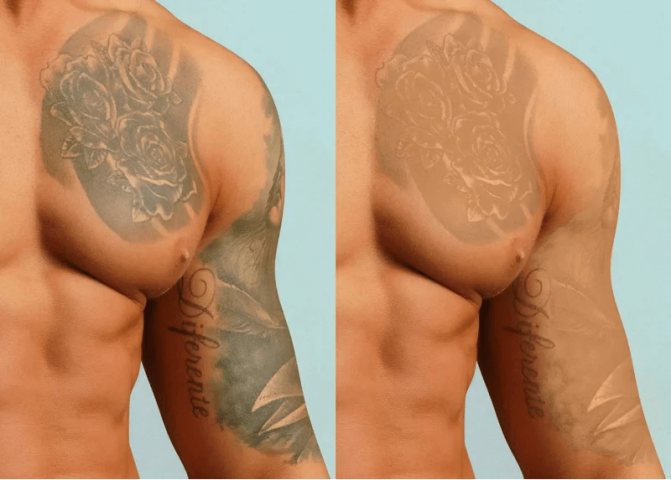 Care tatuaj este mai ușor de îndepărtat