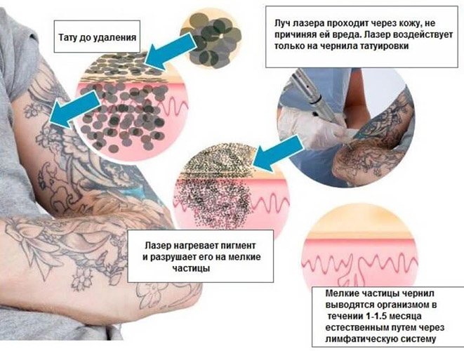 Laser removal of tattoos. Reviews, before and after photos