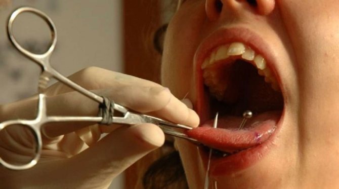 This photo shows the tongue piercing procedure