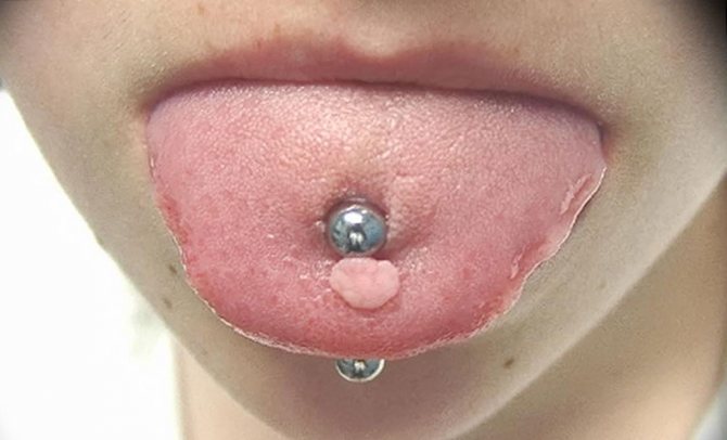 The photo shows a neoplasm that appeared after the piercing