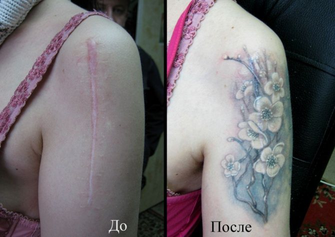 Covering of a scar with a tattoo in the salon