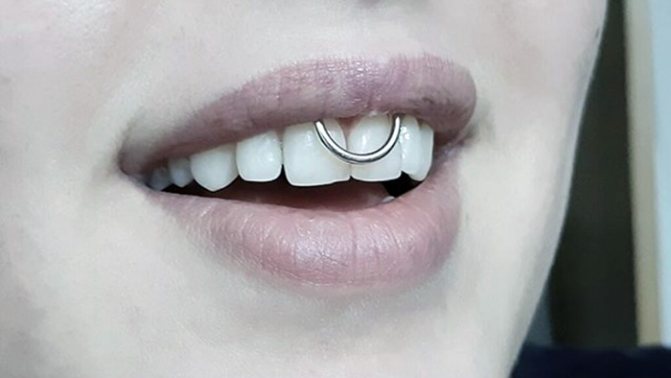 Piercing under the upper lip (smiley) on the frenulum. Photos, consequences, reviews