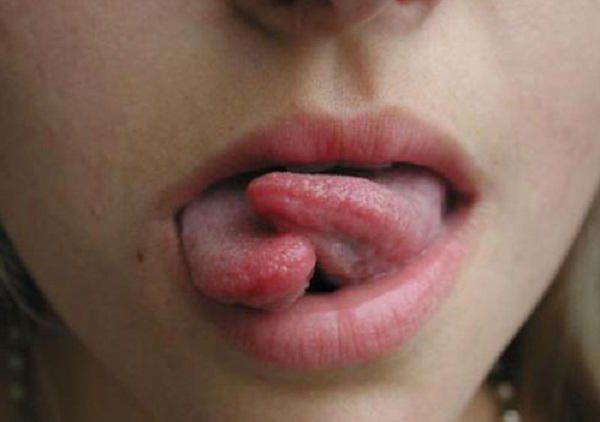 Tongue Split consequences