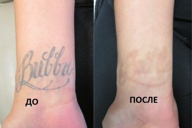 Dissolve tattoos