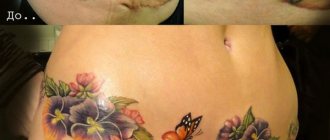 Tatuaj pentru a ascunde cusăturile abdominale după o cezariană