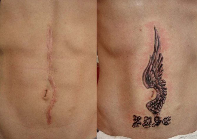Tattoo on scars