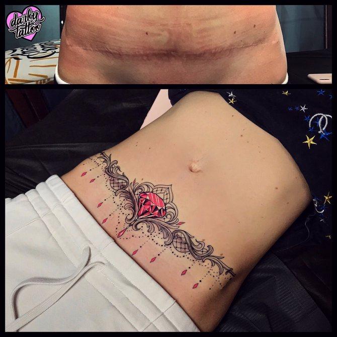 Tattoo on C-section scar