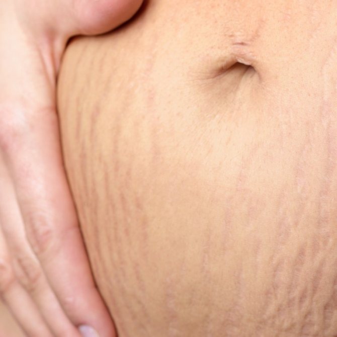 Tattoo on abdomen after childbirth on stretch marks