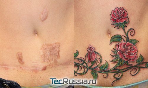 Tattoo on your belly hides scar after surgery