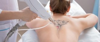 Tattoo Removal by Laser
