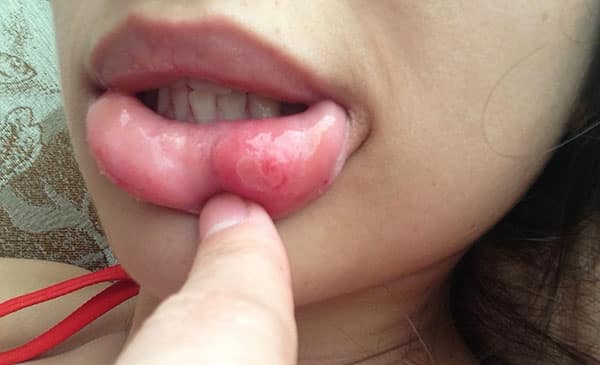 Lip piercing inflammation