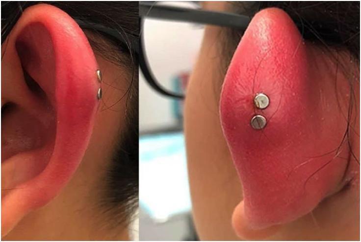 Inflammation after piercing