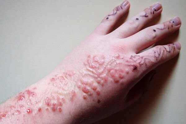 Possibili complicazioni nell'applicazione dell'henné