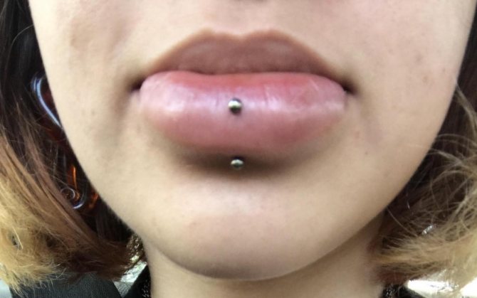 Possible consequences of a vertical labret
