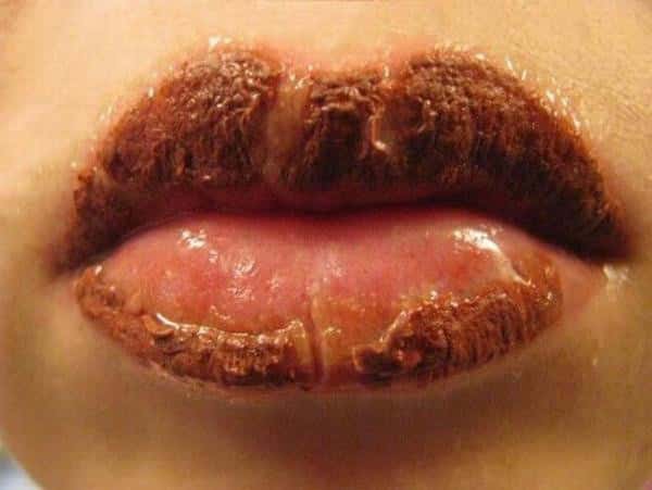 Healing of the lips